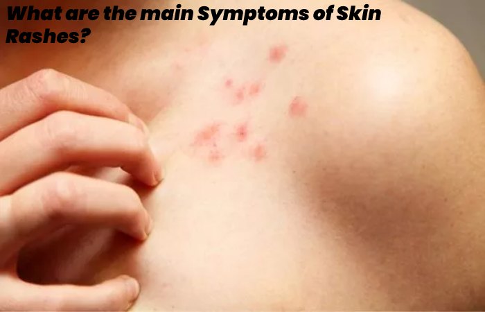What are the main Symptoms of Skin Rashes?